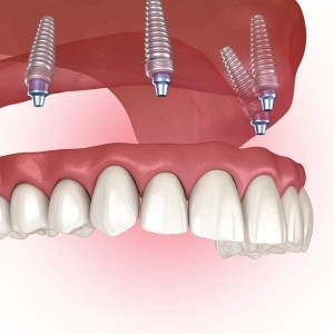 Illustration showing dental implants supporting an upper denture